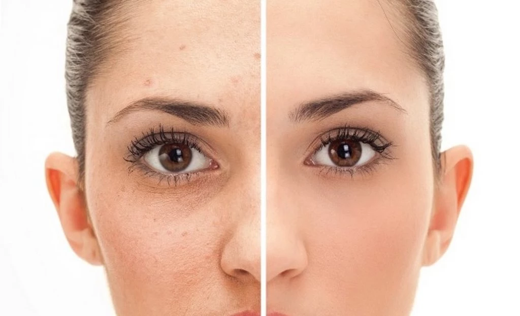 Son acumulaciones de melanina que se producen de manera irregular